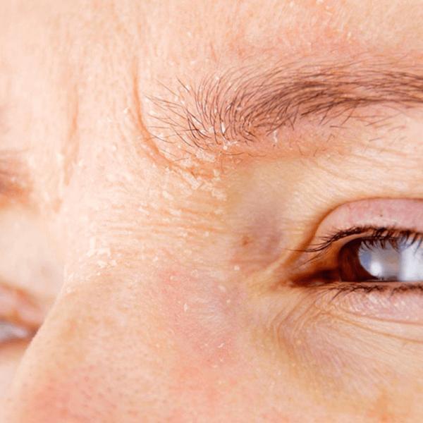 Seborrheic Dermatitis: More Than Just Flaky Skin