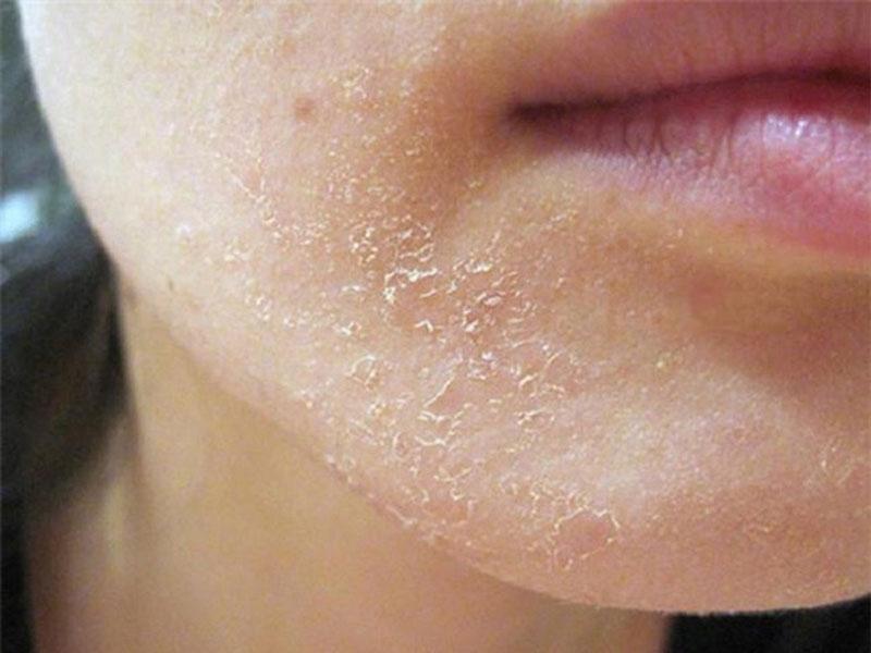 When Flaking Skin Is More Than Dandruff: Understanding Seborrheic Dermatitis