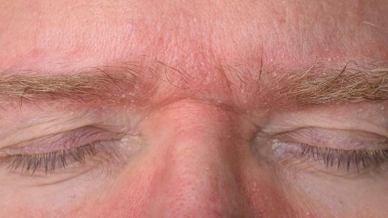 Why Does the Skin Keep Flaking? A Closer Look at Seborrheic Dermatitis