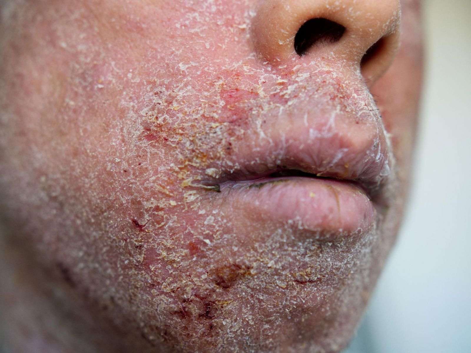The Truth Behind Persistent Scalp Flakes and Facial Redness