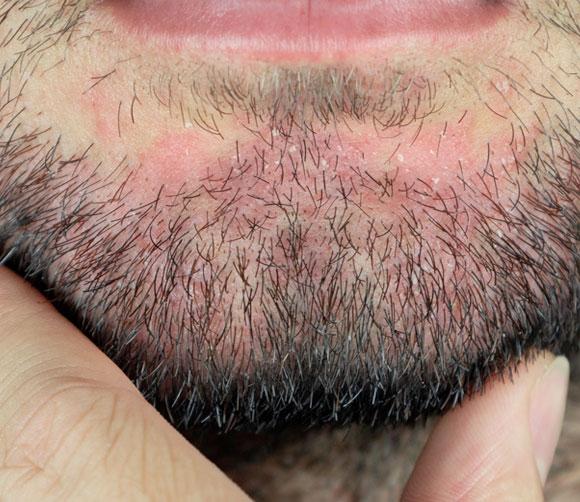 When Redness and Flakes Refuse to Go Away: Understanding Seborrheic Dermatitis