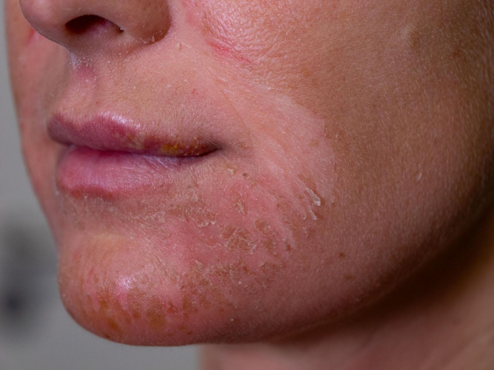 Why Is My Skin Constantly Flaking? Understanding Seborrheic Dermatitis Beyond Dandruff