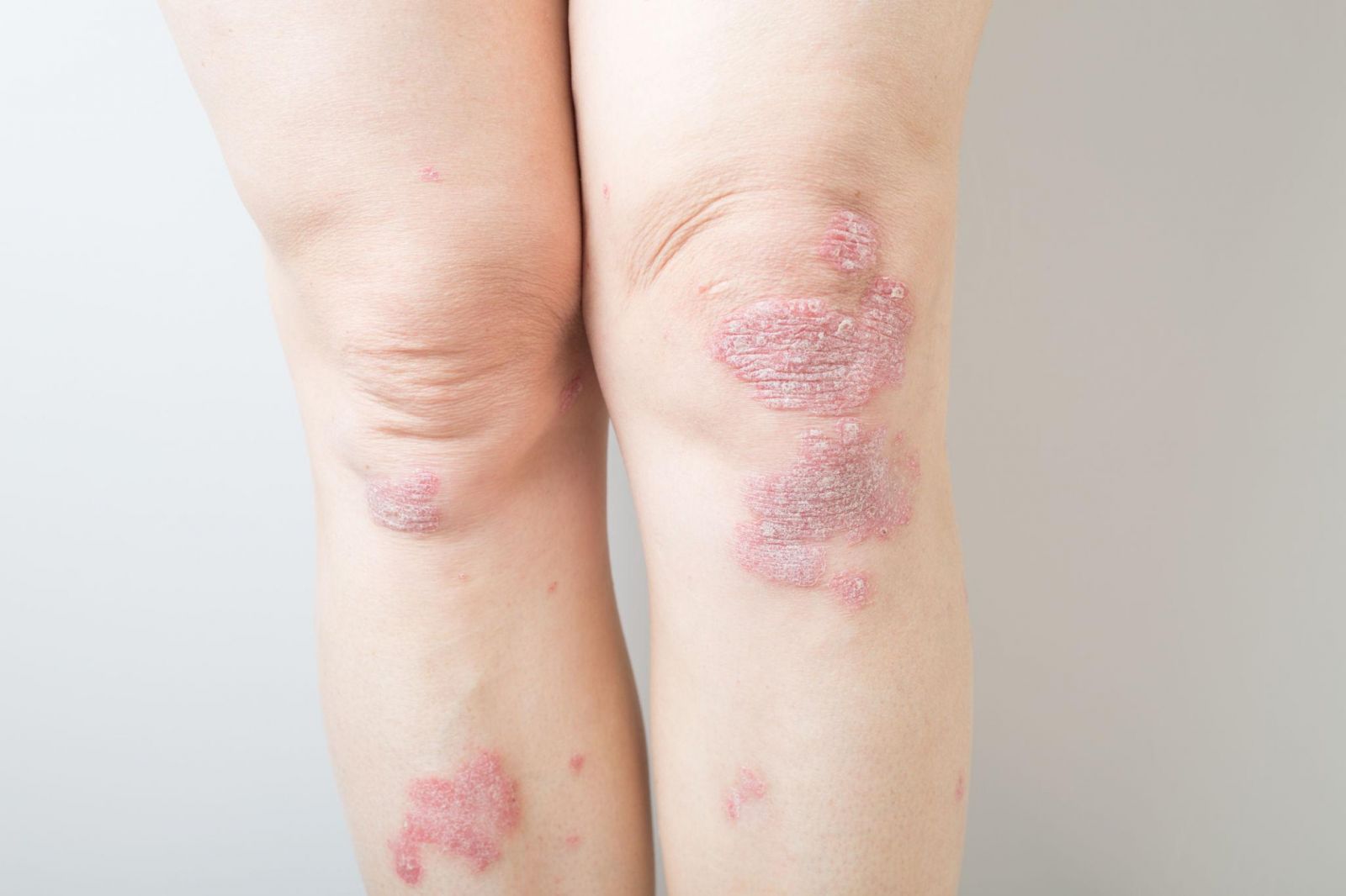 Psoriasis: Understanding a Chronic Skin Condition
