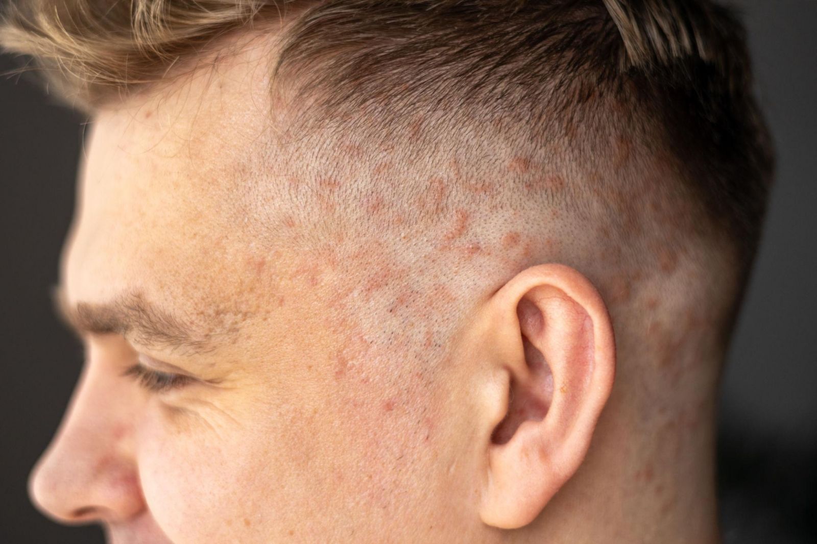 Psoriasis Skin Disease: Causes, Symptoms, and Daily Impact