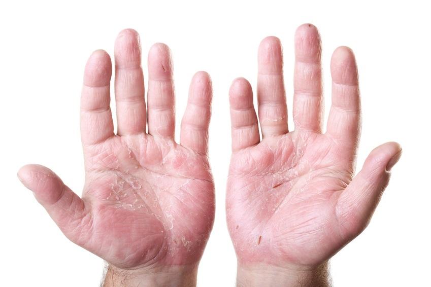 Eczema: A Common Condition Linked to Dry and Sensitive Skin
