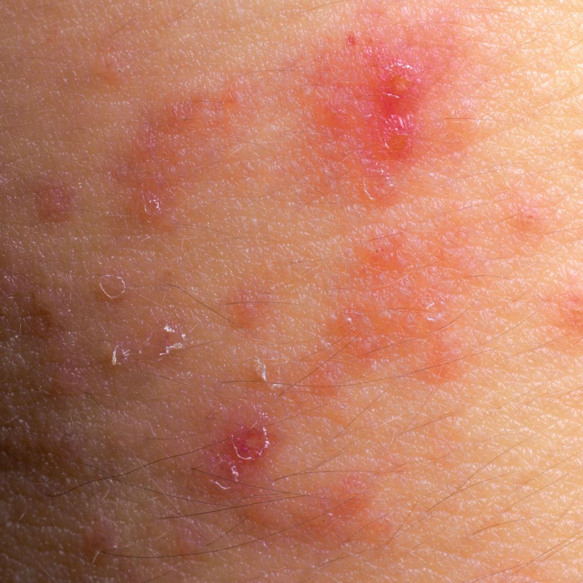 Why Does Eczema Keep Returning? Understanding Chronic Skin Irritation