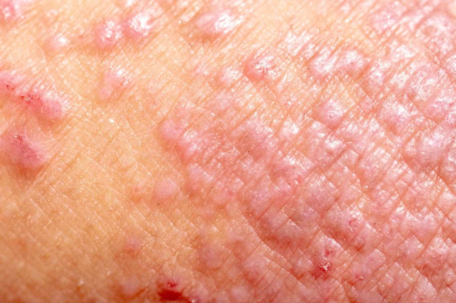 The Hidden Reasons Behind Persistent Eczema Symptoms
