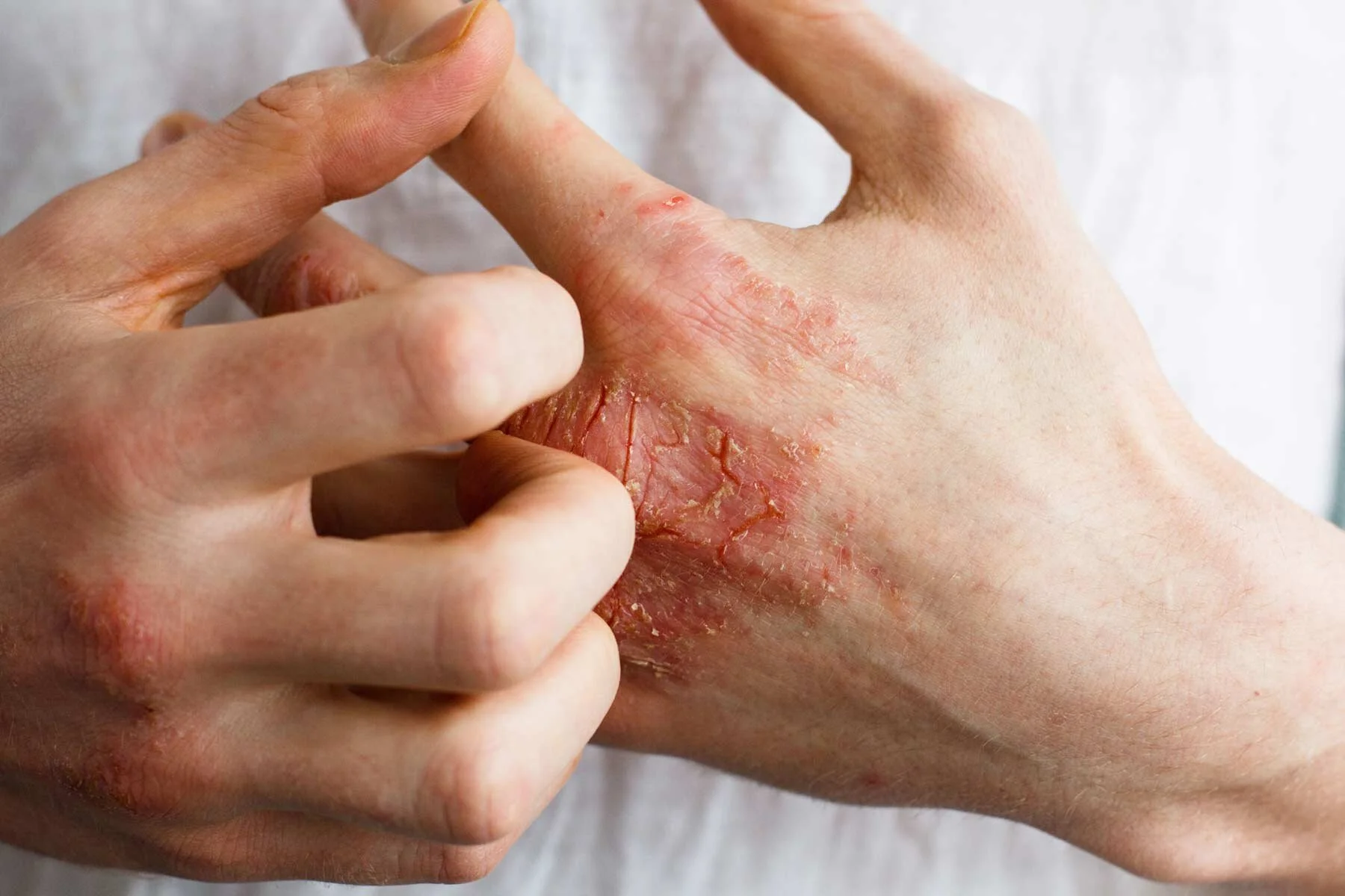 Understanding the Causes of Eczema