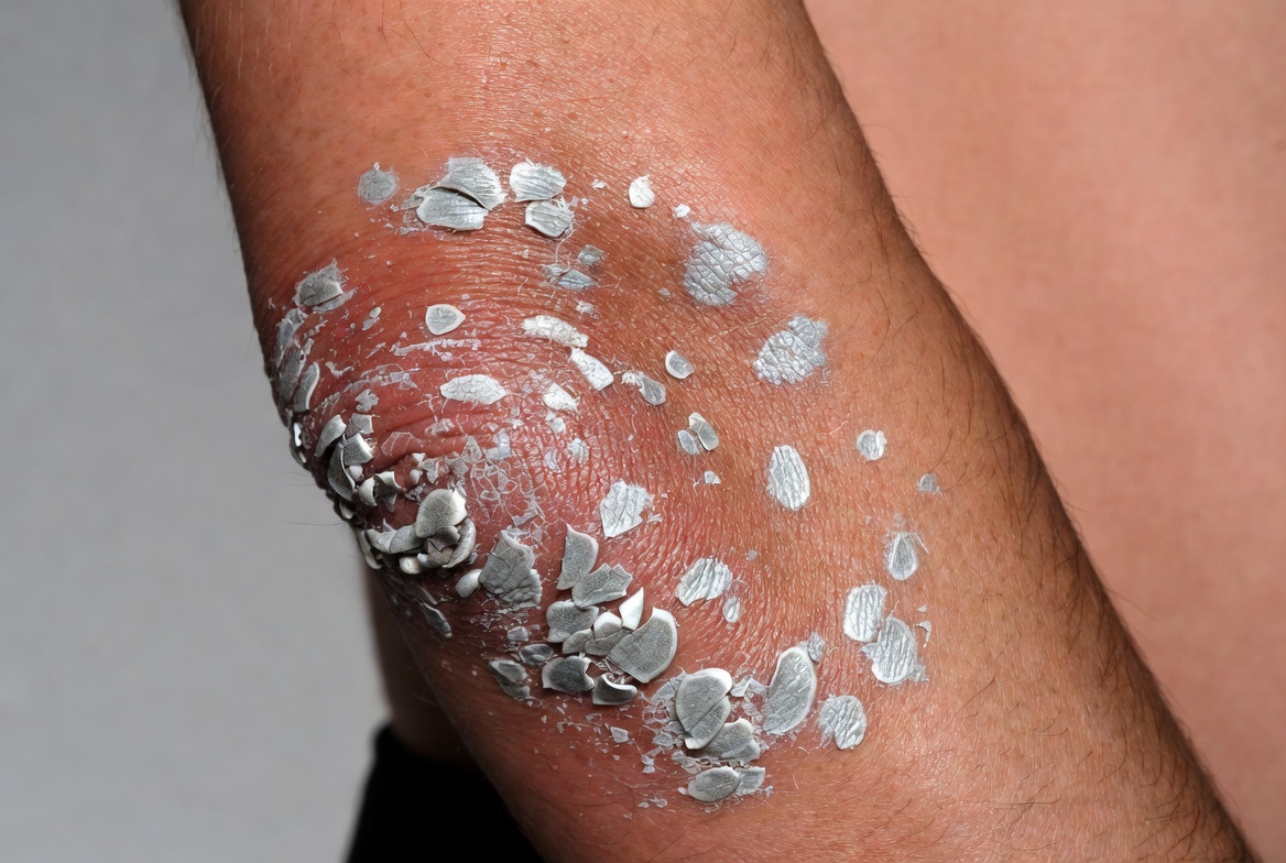 Why Does Psoriasis Keep Coming Back? Understanding Recurrent Flares and Long-Term Management